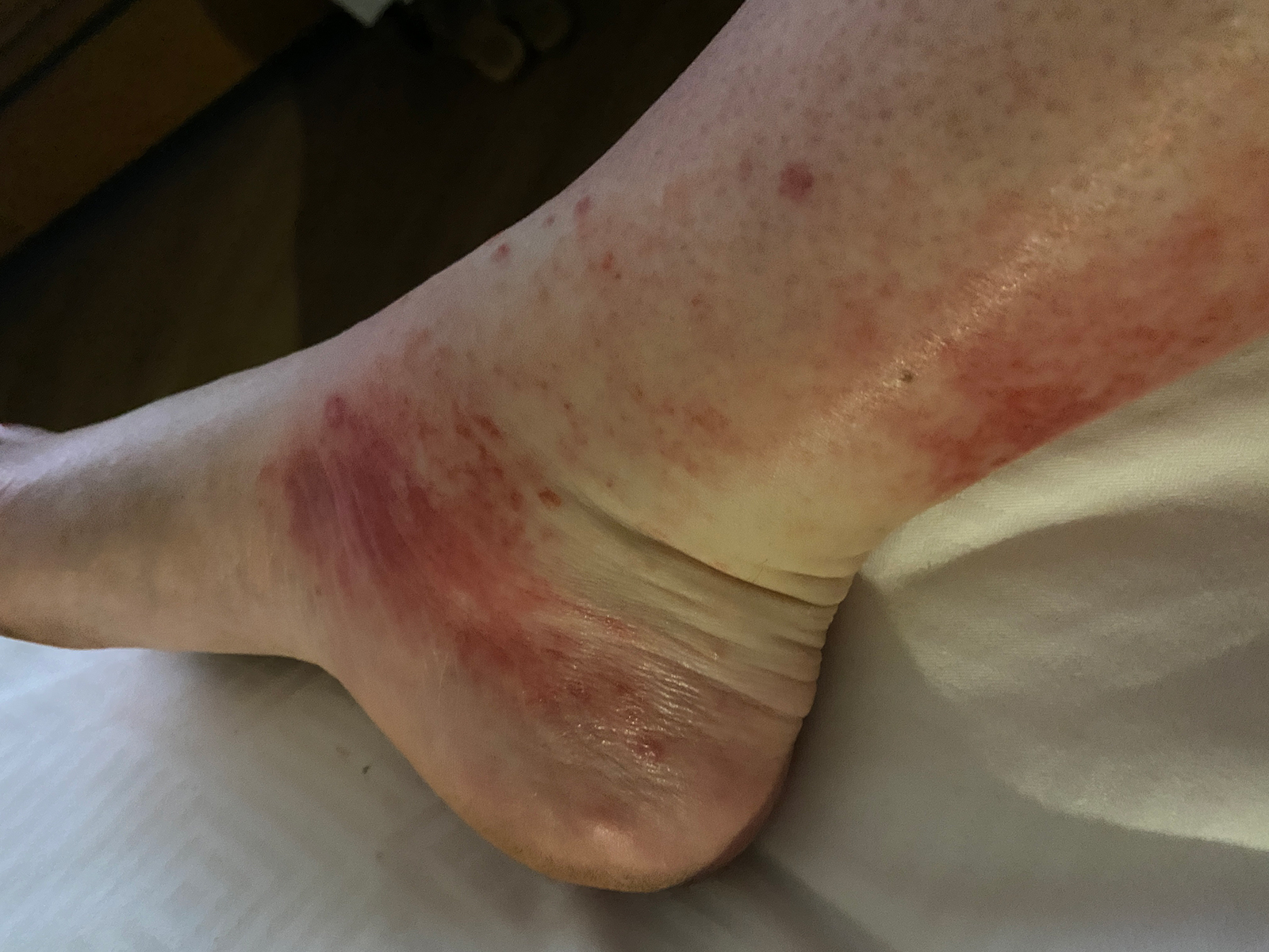 Ankle with red, angry skin