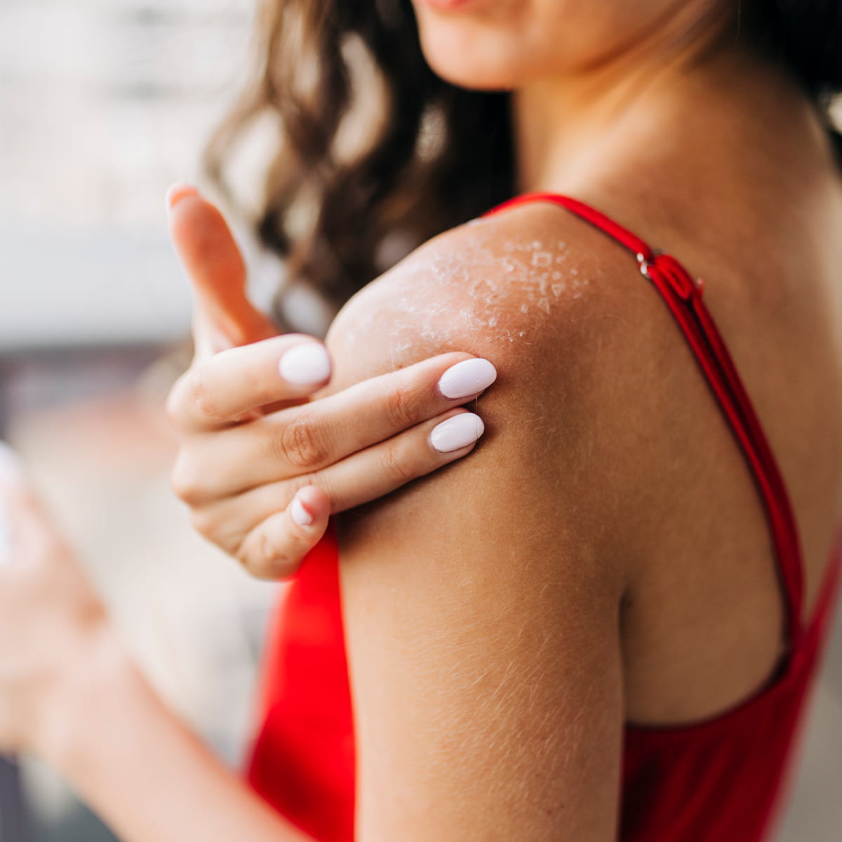 women applying aloe gel on dry shoulder