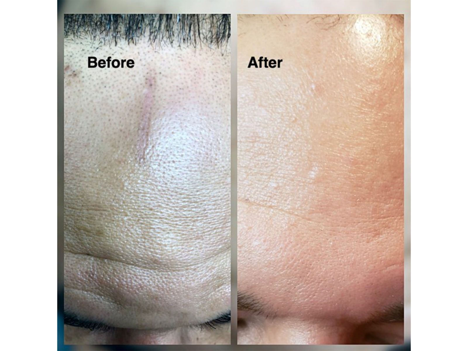 Side by side of man's forehead